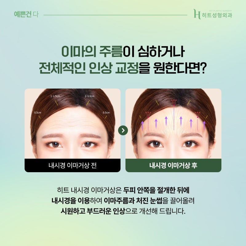 [히트성형외과] 이마거상, 눈썹하거상 어떤 차이가 있을까? 사진 3