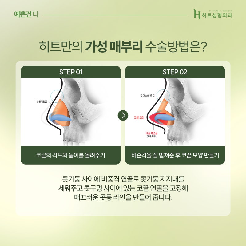 [히트성형외과] 매부리코 종류별 특징은? 사진 5