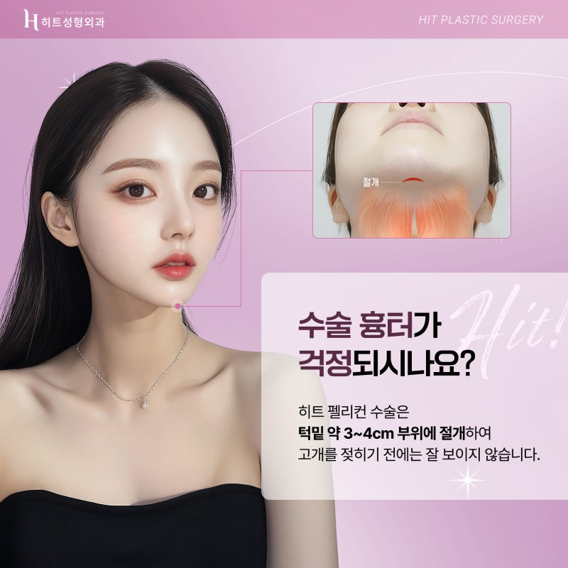 [히트성형외과] 목과 턱의 경계를 찾아주다, 히트 펠리컨 수술! 사진 4