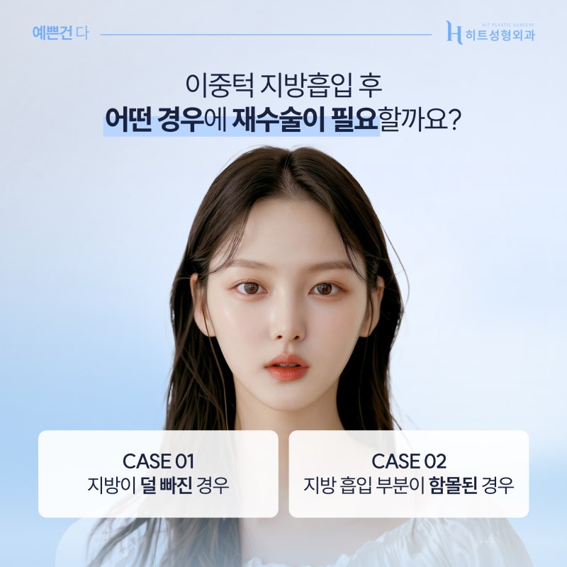 [히트성형외과] 이중턱지방흡입 재수술 케이스는?