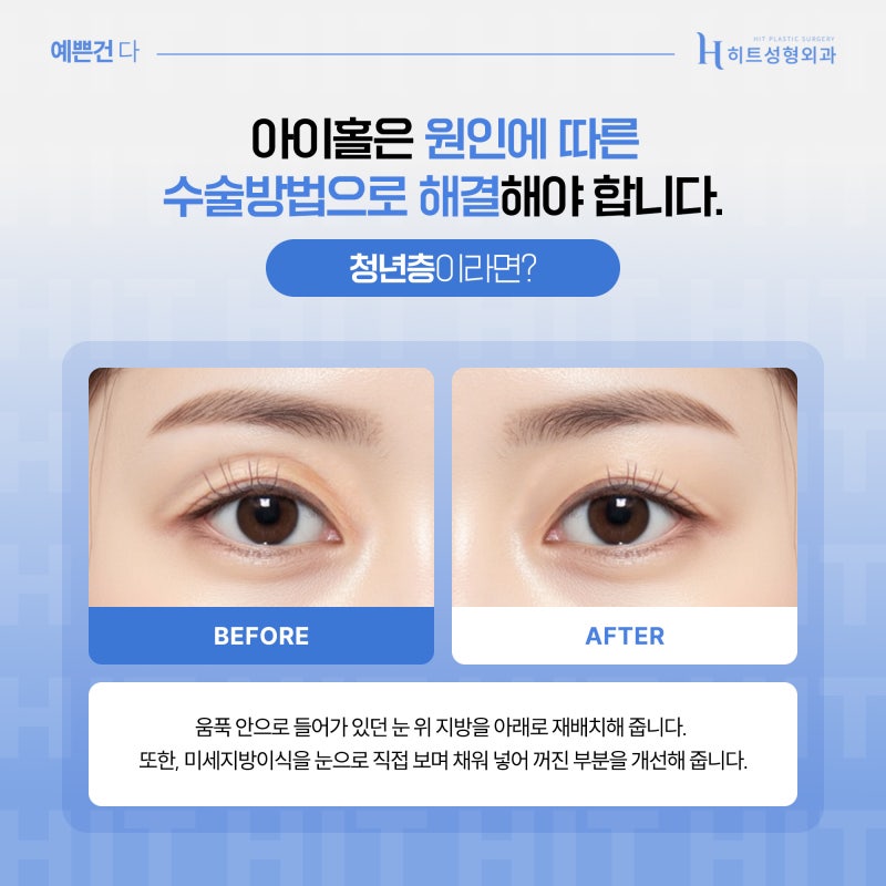 [히트성형외과] 아이홀이 생기는 원인은? 사진 5
