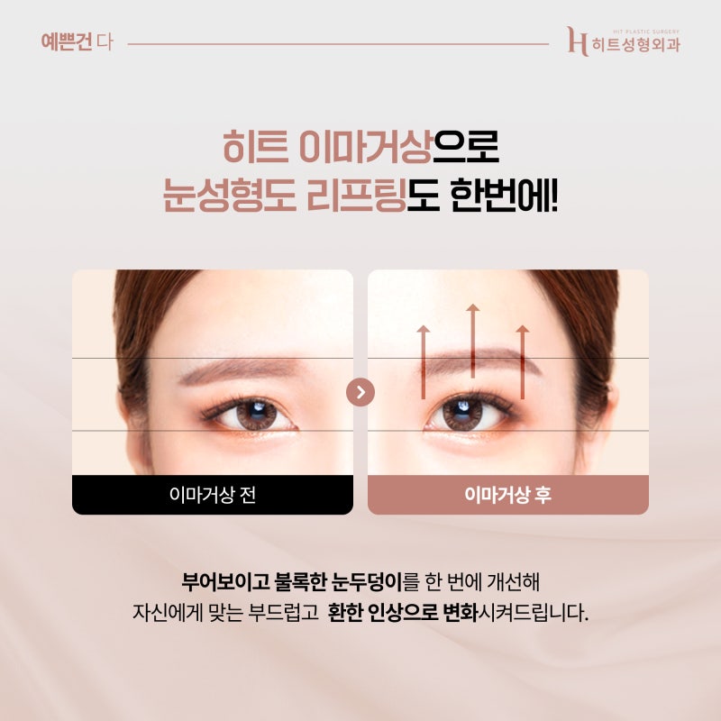 [히트성형외과] 눈두덩이가 부어보인다면? 사진 5