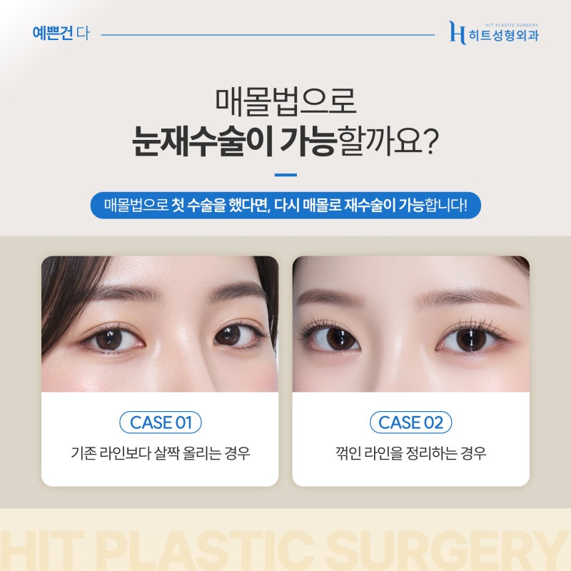 [히트성형외과] 눈 재수술 자연유착으로 가능할까?