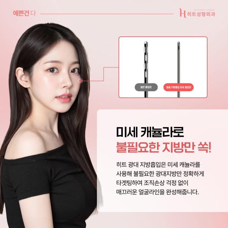[히트성형외과] 광대뼈 문제가 아니라면 광대살 지방흡입으로! 사진 5