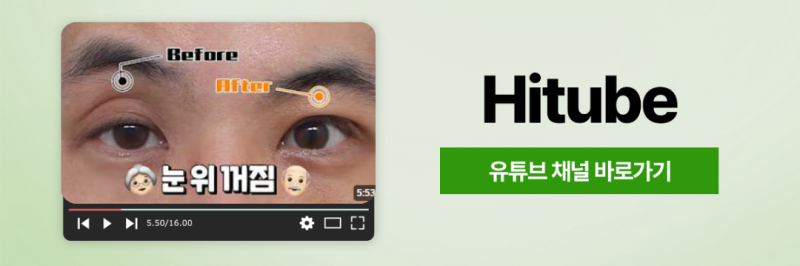 [히트성형외과] 눈꺼풀 처짐으로 생긴 인상 변화, 해결 방법은? 사진 8