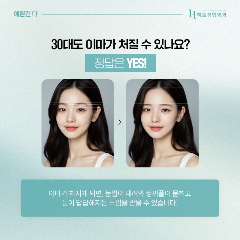 [히트성형외과] 이마 거상, 30대 젊은 연령대에도 가능할까?