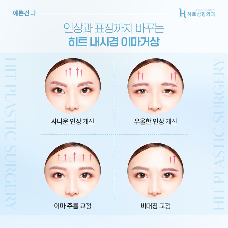 [히트성형외과] 눈꺼풀 처짐, 이마거상으로 개선하는 이유는? 사진 4