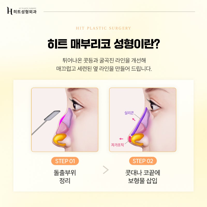 [히트성형외과] 내 얼굴에 맞는 코 유형, 어떻게 구분할까요? 사진 4