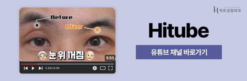 [히트성형외과] 짝눈 교정, 어떤 수술이 정답일까요? 사진 8