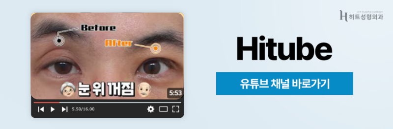 [히트성형외과] 눈 밑 다크서클, 눈밑지방재배치로 개선할 수 있을까? 사진 8