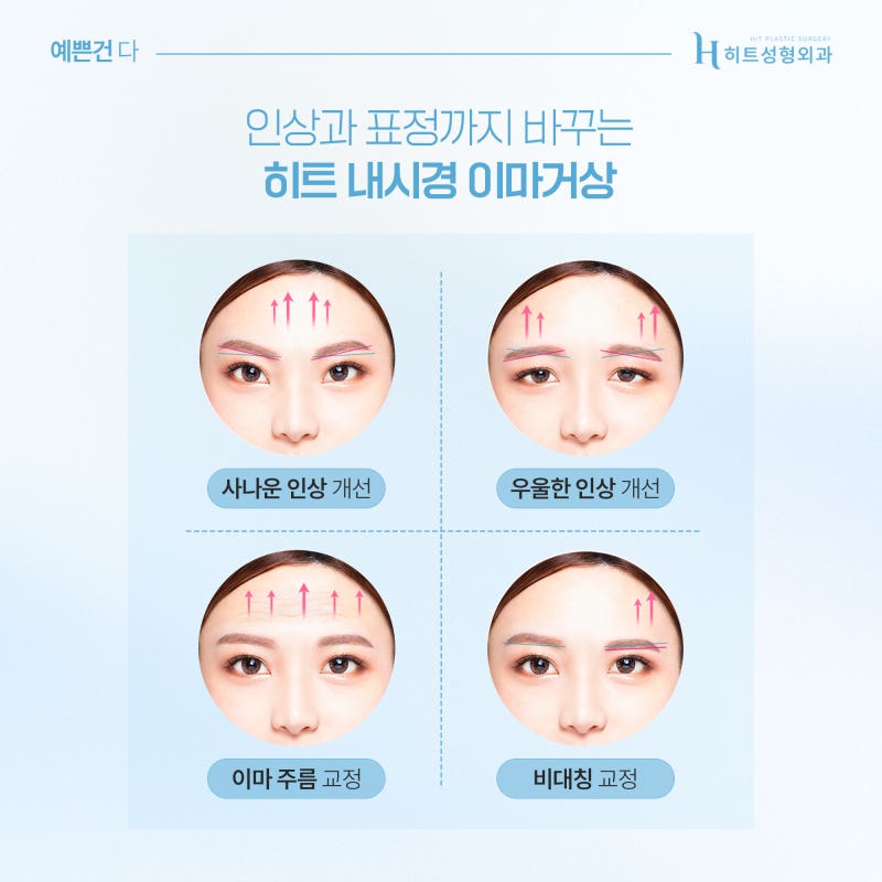 [히트성형외과] 눈매교정과 이마거상의 차이점은? 사진 6