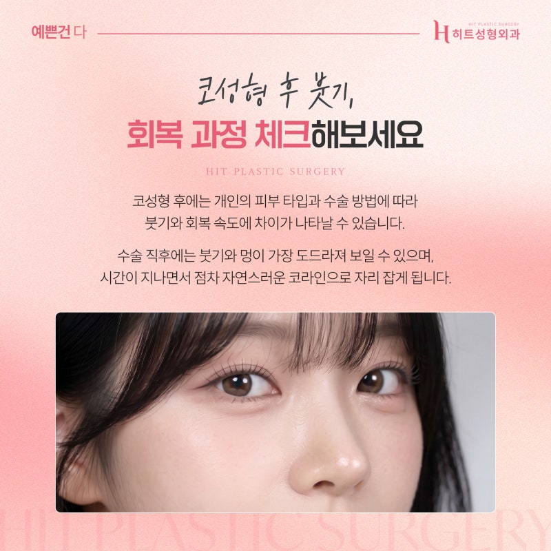 [히트성형외과] 코성형 후 붓기, 언제 자연스러워질까요?