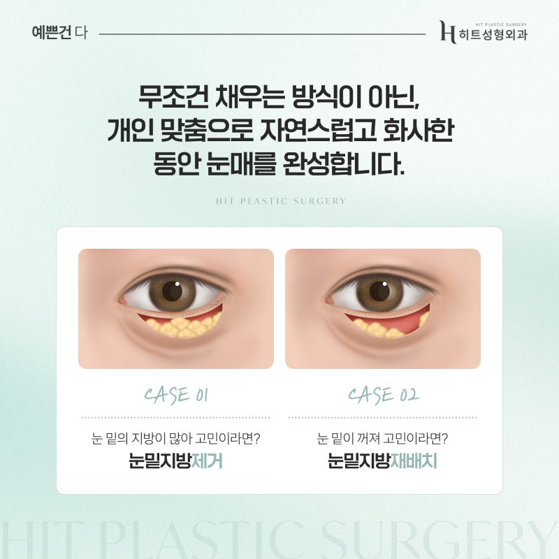 [히트성형외과] 눈 밑 꺼짐 vs 지방 돌출, 어떤 수술이 필요할까? 사진 4