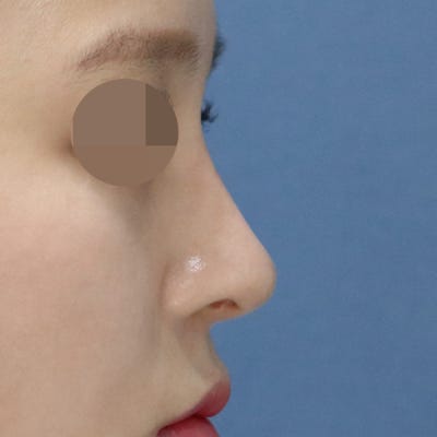 히트성형외과 코성형 (콧볼축소, 복코교정) 사진 6