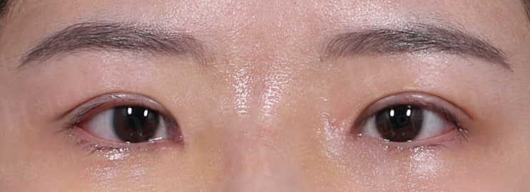 쌍꺼풀 겹주름이 눈성형을 하면? [히트성형외과] 사진 2