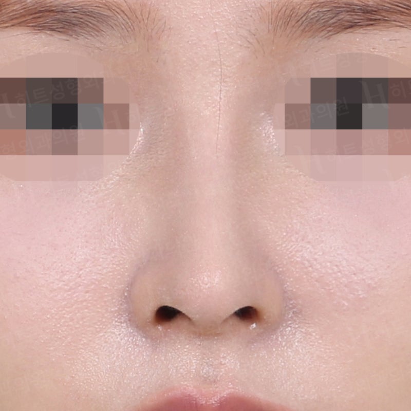 비순각 교정과 코끝교정으로 화살코 극복 [히트성형외과 코성형] 사진 2