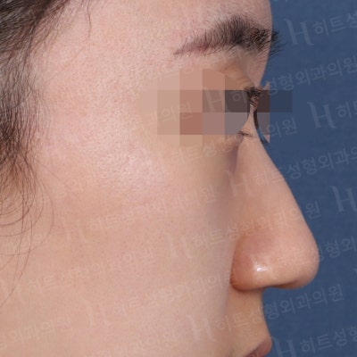 복코교정, 유형에 따라 다른 수술방법! [히트성형외과 코성형] 사진 5