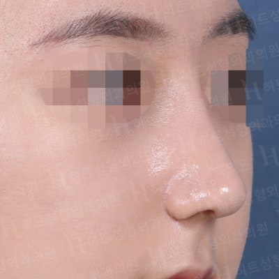 복코교정, 유형에 따라 다른 수술방법! [히트성형외과 코성형] 사진 4