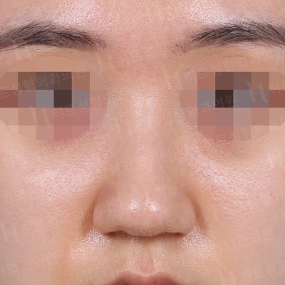 복코교정, 유형에 따라 다른 수술방법! [히트성형외과 코성형]