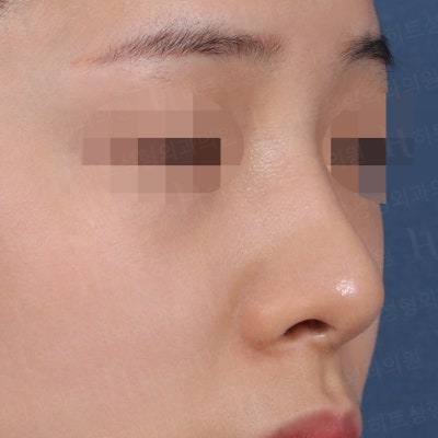 코성형 재수술 후기 [히트성형외과 코성형] 사진 2