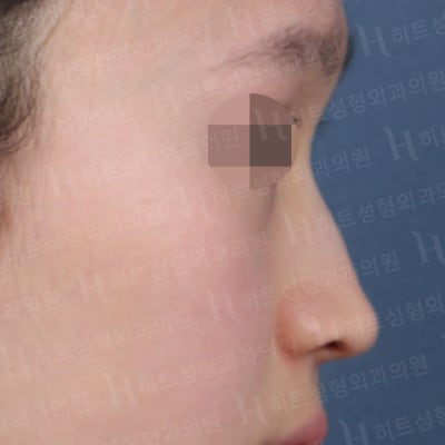 메부리코+복코 완벽개선 [히트성형외과 코성형] 사진 3