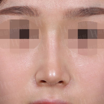 메부리코+복코 완벽개선 [히트성형외과 코성형] 사진 4