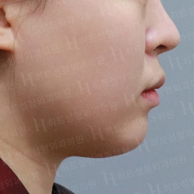다이어트를 해도 안 빠지는 얼굴살? [히트성형외과] 사진 3