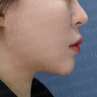 다이어트를 해도 안 빠지는 얼굴살? [히트성형외과] 사진 6