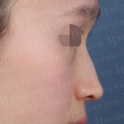 튀어나온 매부리코, 매끈한 콧대로 개선 [히트성형외과 코성형] 사진 3