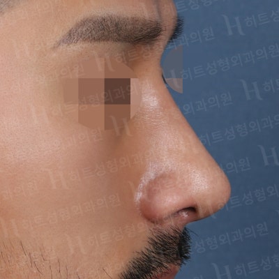 남자코성형 매부리,복코 매끈하게 개선하기 위해서는 [히트성형외과] 사진 6