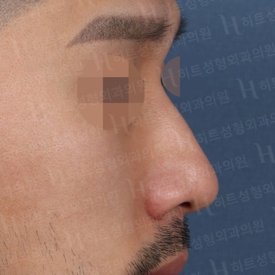 남자코성형 매부리,복코 매끈하게 개선하기 위해서는 [히트성형외과] 사진 3