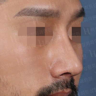 남자코성형 매부리,복코 매끈하게 개선하기 위해서는 [히트성형외과] 사진 5