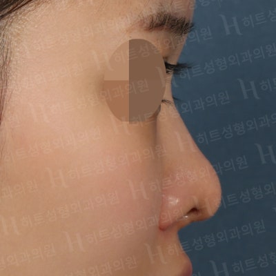 흰코, 코재수술 본인에게 맞는 수술방법으로! [히트성형외과] 사진 5