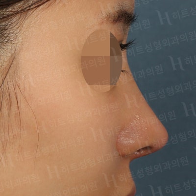 흰코, 코재수술 본인에게 맞는 수술방법으로! [히트성형외과] 사진 6