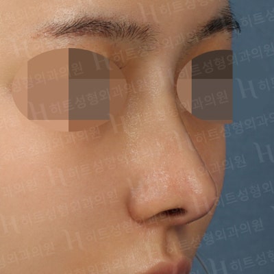 흰코, 코재수술 본인에게 맞는 수술방법으로! [히트성형외과] 사진 4