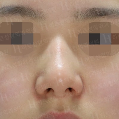 복코교정,매부리교정 세련된 코 라인을 [히트성형외과 - 박정열원장님]