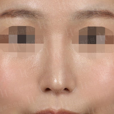 매부리코,비순각,복코교정 나에게 맞는 수술플랜으로! [히트성형외과-한상철원장님] 사진 2