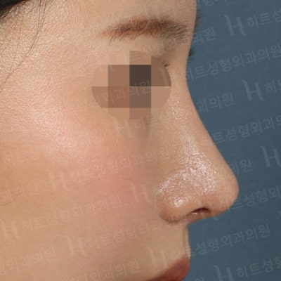 매부리코,비순각,복코교정 나에게 맞는 수술플랜으로! [히트성형외과-한상철원장님] 사진 6