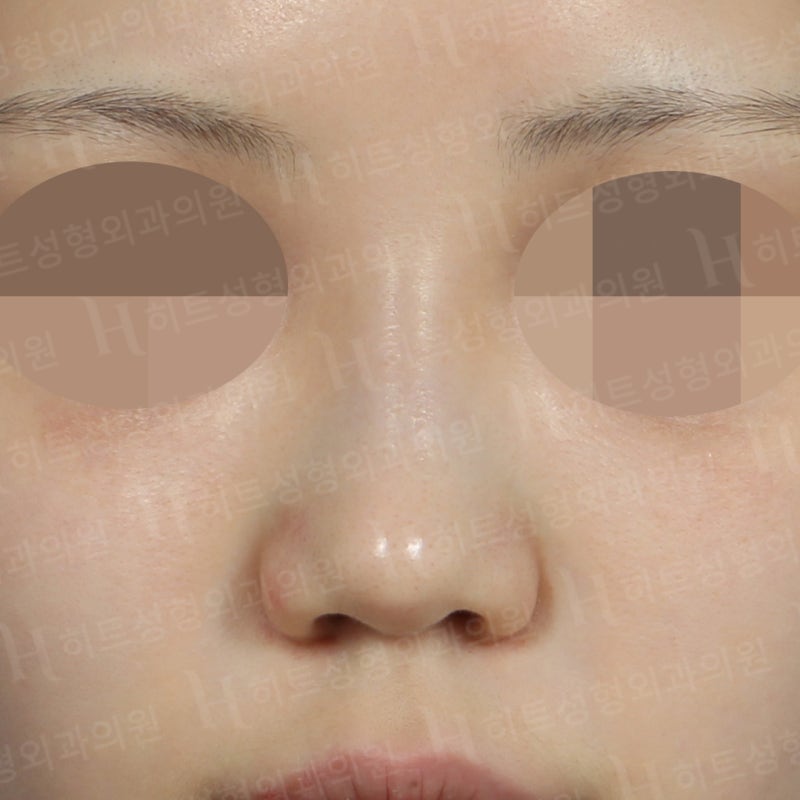 낮은 복코를 카리나코처럼 개선! [히트성형외과] 사진 5