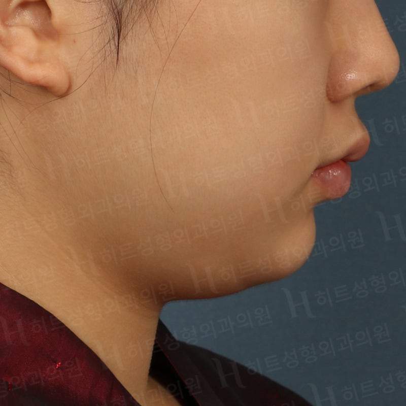 이중턱지방흡입후기 [히트성형외과]