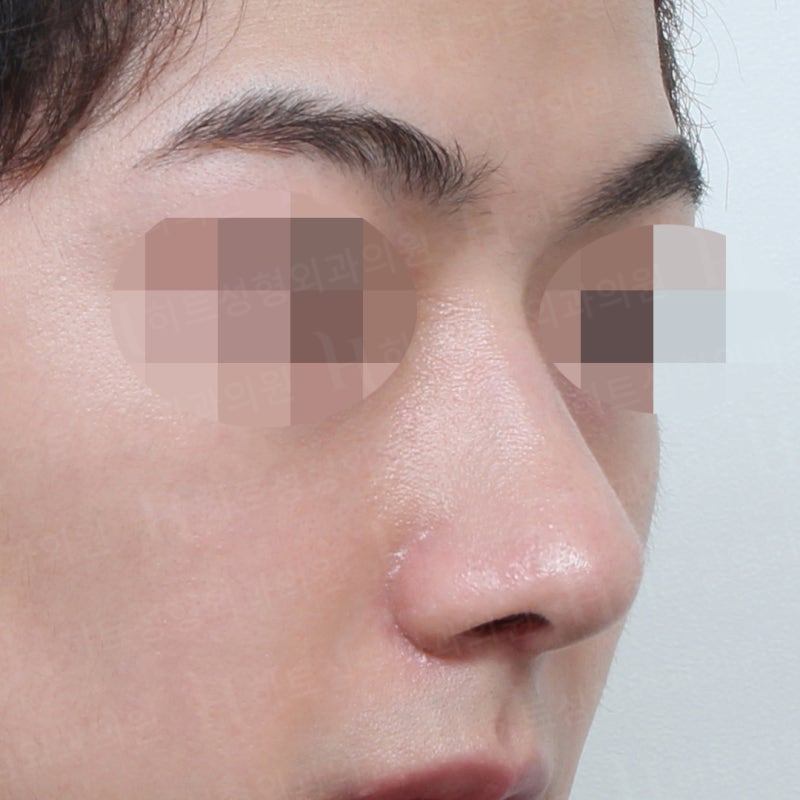 남자코수술전후 코끝만 교정 사례 사진 4