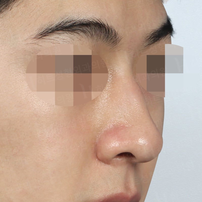 남자코수술전후 코끝만 교정 사례 사진 3