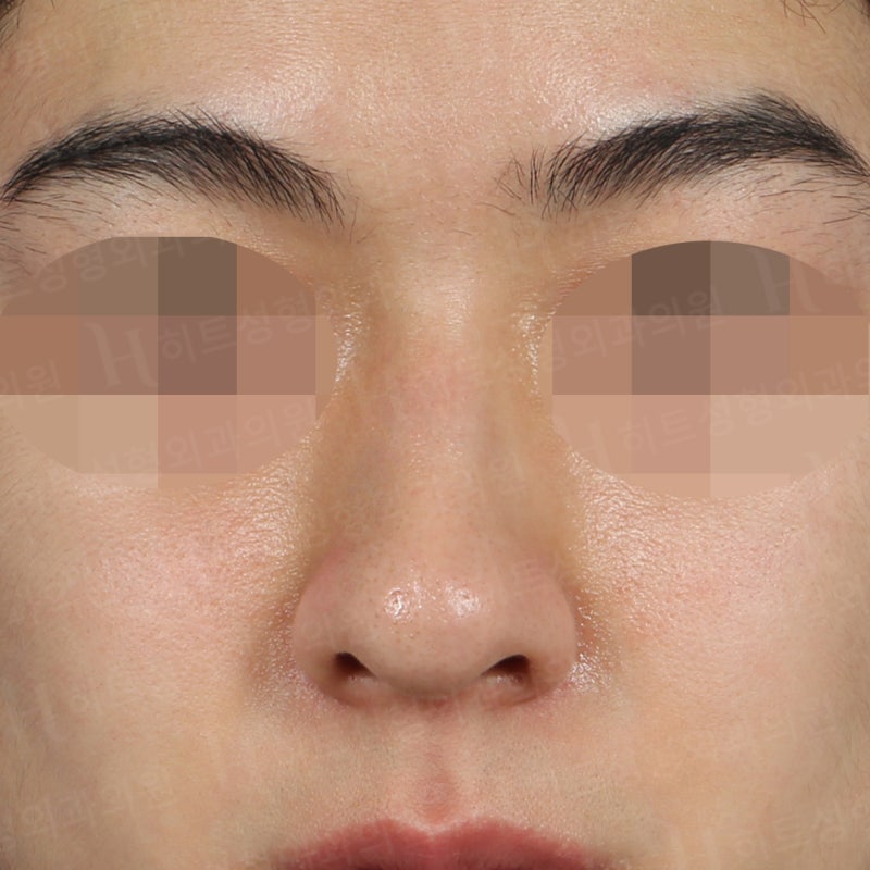 남자코수술전후 코끝만 교정 사례 사진 5