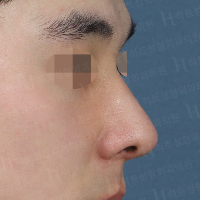 남자코성형 전후, 전형적인 매부리코 사례 사진 2