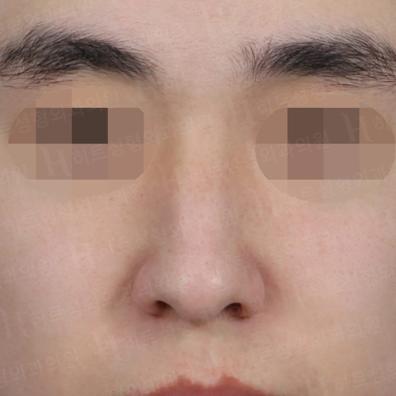 남자코성형 전후, 전형적인 매부리코 사례 사진 5