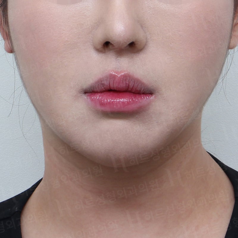 얼굴지방흡입 재수술로 V라인 완성! [히트성형외과] 사진 2