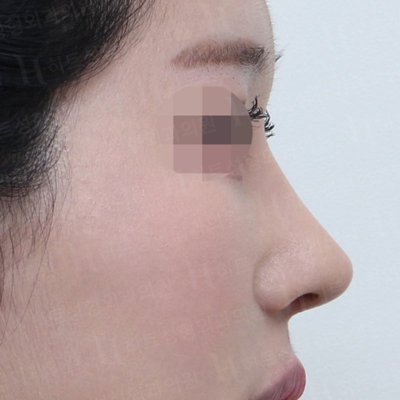 복코교정으로 얄쌍하게! [히트성형외과] 사진 6