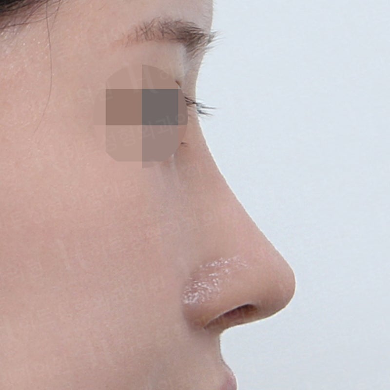 코재수술 사례, 재수술 할 때 중요한 점 사진 2