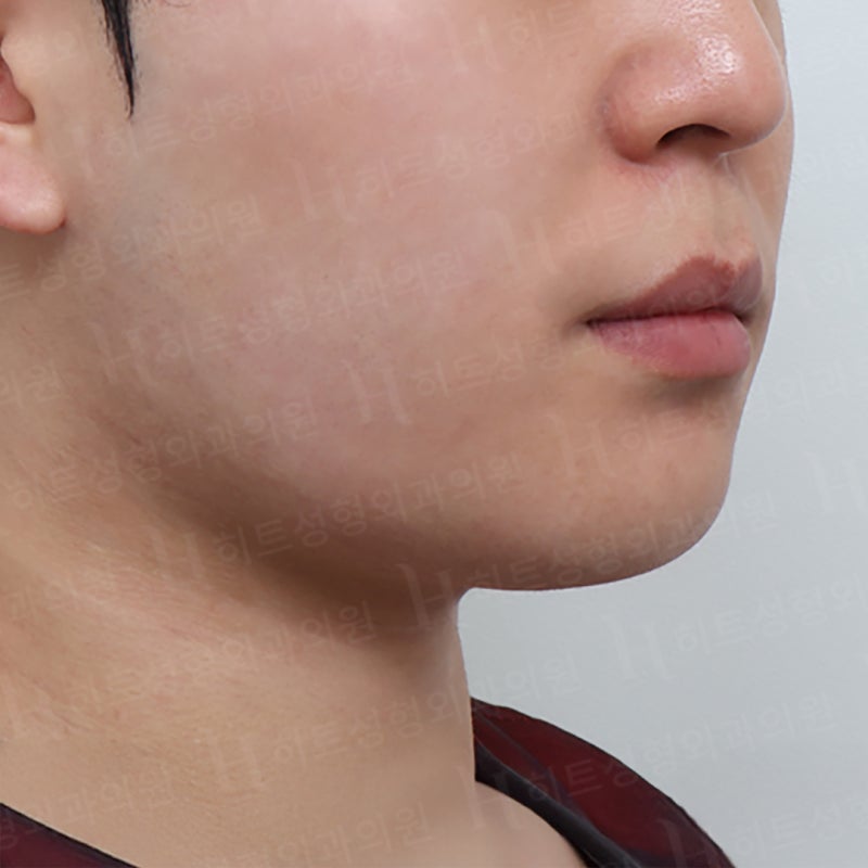 아이돌 얼굴형 만드는 얼굴지방흡입수술 사진 2