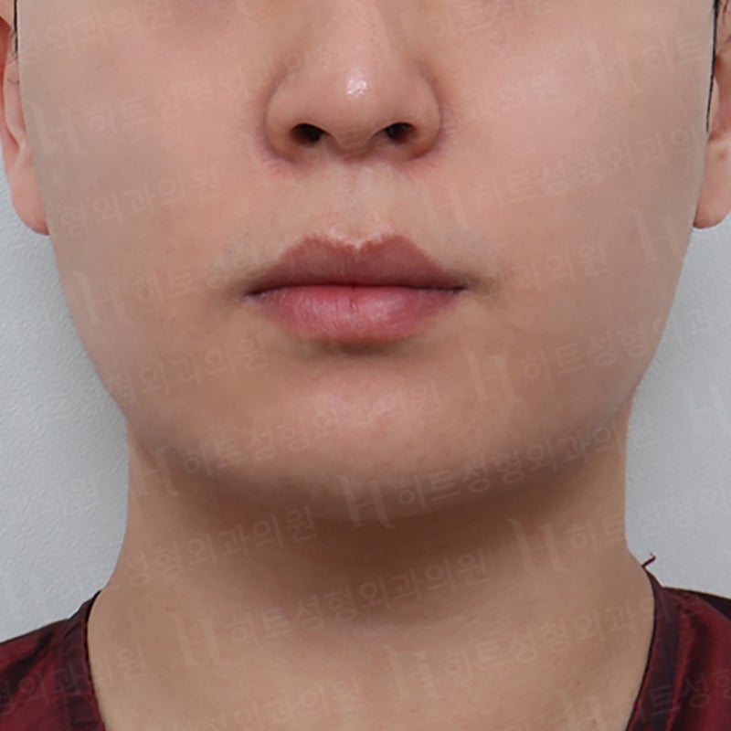 아이돌 얼굴형 만드는 얼굴지방흡입수술 사진 3
